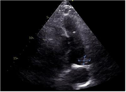 Pulmonary artery in situ thrombosis due to patent ductus arteriosus: a case report